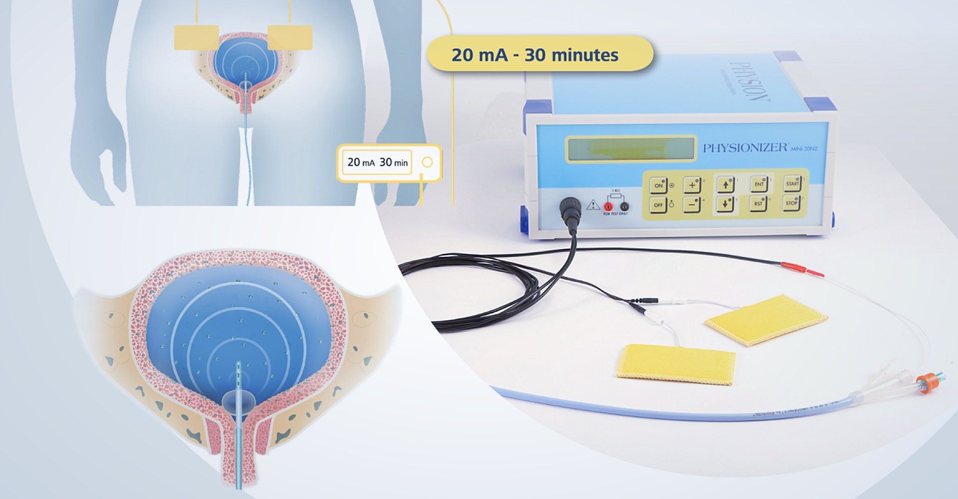 Physionizer Mini 30N2 is a device that enables the Electromotive drug administration (EMDA), a non-invasive method of enhancing local drug penetration across the urothelium of the bladder.